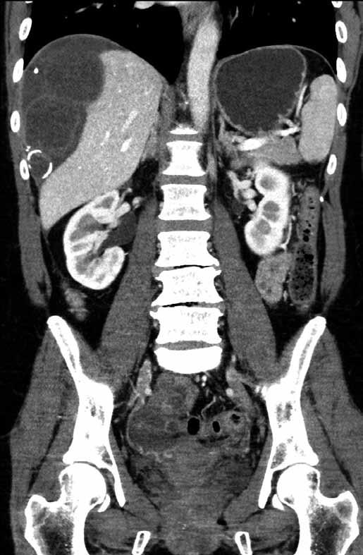infiltrace omenta (šipka) Fig. 4. Contrast-enhanced CT scan of the abdomen in 2015.