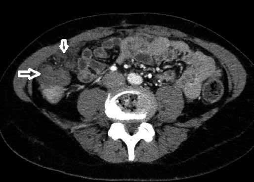 infiltration of the omentum (arrowed) Tumorózní nodularity bývají podél peritonea a omenta, někdy dochází i k obstrukci střev.