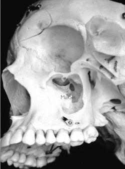 d) facies nasalis hiatus sinus maxillaris (uvnitř dutiny nosní) sinus maxillaris recessus