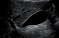 jaterního laloku Fundus (ventrálně dolů), tělo, krček