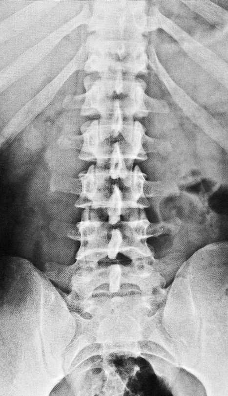 Rtg snímek břicha a pánve Prostý snímek bederní páteře v předozadní projekci. Corpus vertebrae.