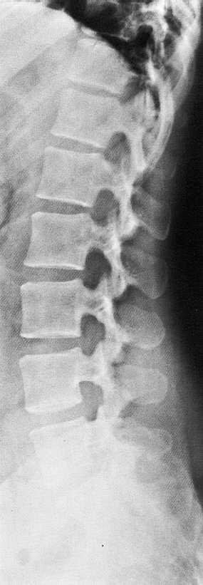 Rtg snímek břicha a pánve Prostý snímek bederní páteře v boční projekci. Corpus vertebrae. Discus intervertebralis.