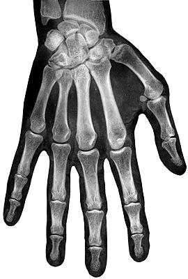 Rtg snímek ruky (dospělý) Prostý snímek kloubů ruky + 9 8 0. Processus styloideus ulnae. Facies articularis carpea. Os scaphoideum. Os lunatum. Os triquetrum.