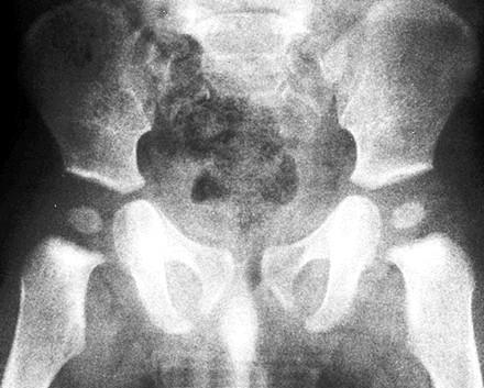 Rtg pánve dítěte Prostý snímek zachycuje jednotlivé kosti tvořící budoucí os coxae U budoucího acetabula se