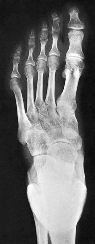 Rtg snímek nohy Prostý snímek kloubů nohy v dorsoplantární projekci 9. Tibia. Fibula 8 8.