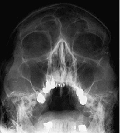 Rtg snímek hlavy Prostý snímek k vyšetření paranasálních dutin (tzv.poloaxiální = Water s).