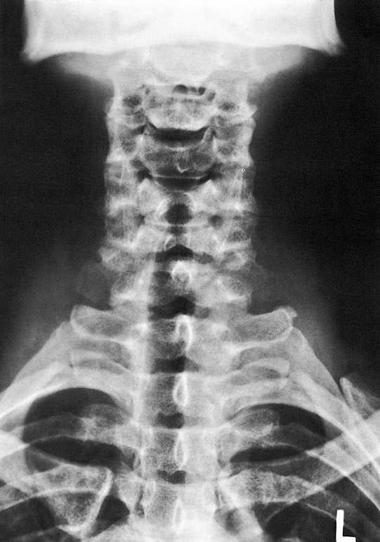 Rtg snímek krku Prostý snímek krční páteře v předozadní projekci. Mandibula. Dens axis.