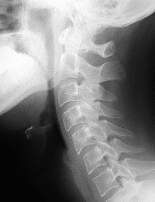 Rtg snímek hlavy a krku Prostý snímek krční páteře v boční projekci. Angulus mandibulae.