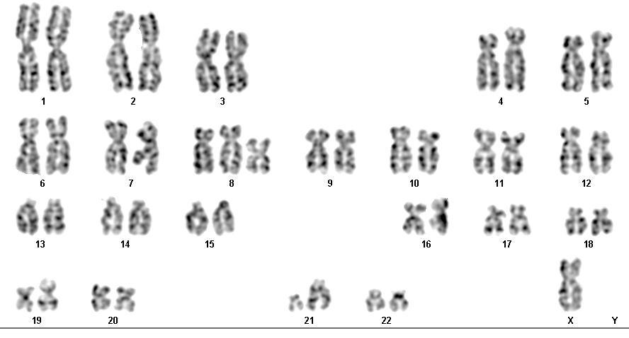 VROZENÉ / ZÍSKANÉ CHROMOSOMOVÉ ABERACE - příklady početní změny aneuploidie trisomie, monosomie nebalancovaný karyotyp G-pruhování chromosomů