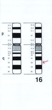 VROZENÉ CHROMOSOMOVÉ ABERACE (VCA) strukturní změny např.