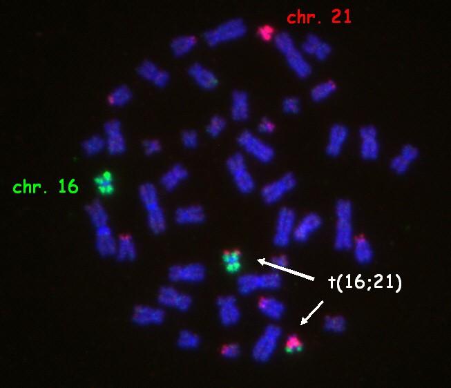 VROZENÉ CHROMOSOMOVÉ ABERACE (VCA) strukturní