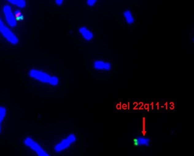 VROZENÉ CHROMOSOMOVÉ ABERACE (VCA) strukturní změny nebalancované aberace mikrodelece (pod