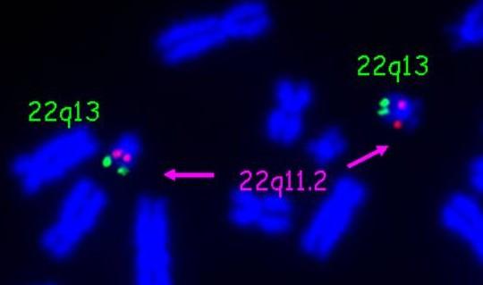 G-pruhování chromosomů vyšetření metodami molekulární cytogenetiky vyšší rozlišovací schopnost