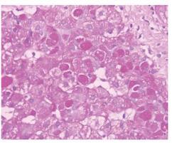 Jaterní glykogenosy výběr - pokračování Glykogenosa III typu (Debrancher Deficiency; deficit amylo 1 6 glukosidasy; Limitní dextrinosa; Coriho nebo Forbesova choroba) Postižena jsou jak játra, tak