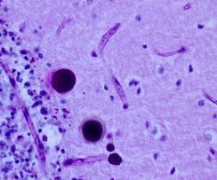 Mozkové glykogenosy Nemoc polyglukosanových tělísek u dospělých (adult polyglucosan body disease) Deficit větvícího enzymu v astrocytech (GSD IV) Pomalu progredující porucha chůze,