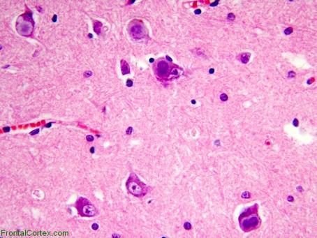 Vzácná choroba, téměř výhradně Aškenázské populaci, AR Laforova choroba Těžká progresivní myoklonická epilepsie se začátkem v adolescenci, progredující demence, afázie, apraxie, vedoucí