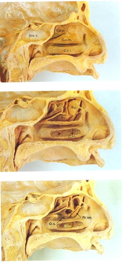 Preparační anatomie podle Hosemanna Dolní a střední skořepa s vyvořeným okénkem. Je patrná bula etmoidalis a ground lamela úponu střední skořepy.