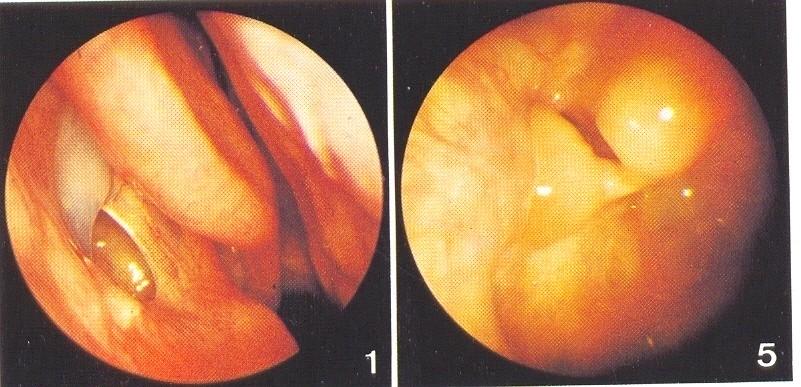 Ostium maxillare secundarium a recirkulace