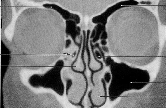 s.front. sinus frontalis pr. unc.