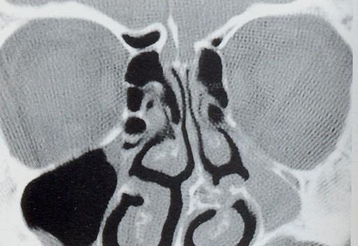 Výrazná vývojová asymetrie velikosti dutiny nosní a paranazálních dutin: aplázie čelistní dutiny vlevo, hypoplázie obou čelních