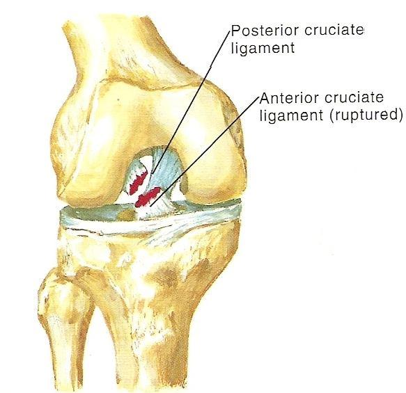 2.4.3 Příznaky poranění LCA Při akutní ruptuře LCA je hlavním příznakem otok kolene, bolestivost, nestabilita kloubu, někdy blokáda kolenního kloubu, také nejistota a slabost končetiny.