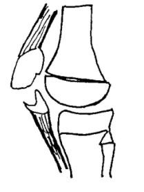 2.5.2 Forma fraktur patelly: Zlomenina příčná Zlomenina roztříštěná s dislokací nebo bez dislokace Zlomeniny vertikální Odtržení apexu čéšky Odtržení horního a zevního pólu čéšky (Typovský, 1981) A B