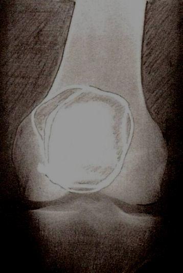 2.5.4 Klinické vyšetření fraktury patelly Je nutné vždy vyšetřit funkci extenzorového aparátu, pacient není schopen extenze kolena z důvodu přerušení extenzorového aparátu.