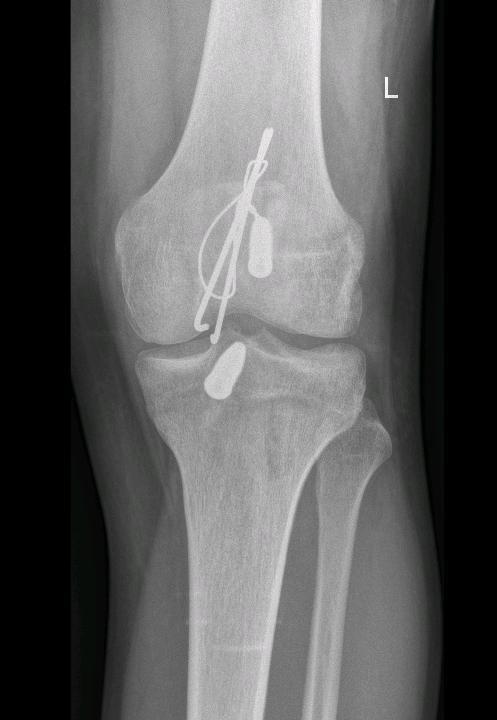 L koleno: zlomenina pately v proximálním pólu