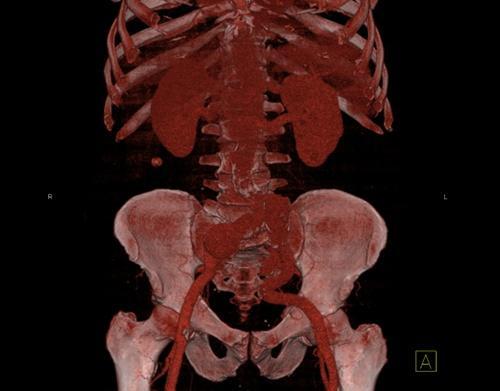Obrázek 1 CT AG snímek zobrazující aneurysma a. iliaca communis bilaterálně (VRT rekonstrukce) EVAR Zdroj: Winmedicalc FN Plzeň 15. 1. 2014 Výkon byl proveden v celkové anestezii.
