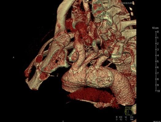 15. 11. 2013 CT AG vyšetření provedeno po aplikaci jodové kontrastní látky podané intravenózně. CT AG vyšetření zobrazilo volné odstupy z aortálního oblouku, a.