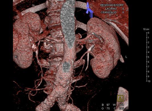 Obrázek 13 CT AG zobrazující subrenální aneurysma břišní aorty (VRT rekonstrukce) Zdroj: Winmedicalc FN Plzeň EVAR 20. 5. 2014 Výkon byl proveden na operačním sále.