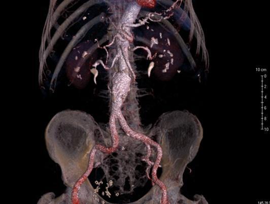a. tibialis anterior a a. fibularis jen do distální třetiny lýtka, vlevo je náplň chabější - náplň ve výrazně kalcifikované a. tibialis posterior je sledovatelná přibližně do poloviny lýtka.