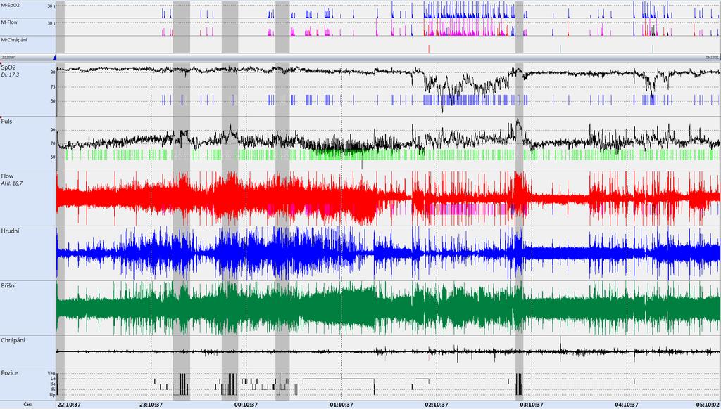 Polygrafie AHI 18,7, ODI 17,6, průměrná