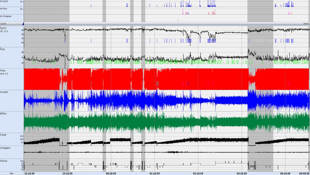 Polygrafie + CPAP 11 mbar AHI 2,8, ODI 9,6,