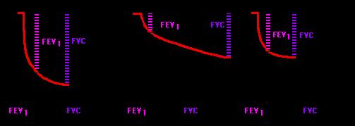 Objem (litry) Rozepsaný usilovný výdech 7-6 - 5-4 - 3-2 - FEV 1 FVC 0 1 2 3 Čas (sec) FEV 1 = objem vydechnutý za 1 sec (~80% FVC) FVC = objem všeho vydechnutého vzduchu (Forced Vital