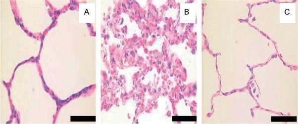 (pneumothorax, ) Zvyšuje se při