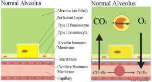 ARDS (Acute Respiratory Distress Syndrom) Poškozený alveolární epitel vdechnutím škodliviny (popáleniny, chemikálie, ) Poškozený kapilární endotel škodlivinami v krvi