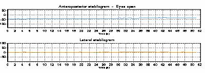 KAZUISTIKA Pacientka s FPV č.3 r. 50 NA: ataky závratí s nevolností, nejistota, tah doprava, nejde o rotační závrať, bez pádů, trvají cca.