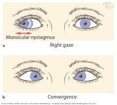 Postižení mezencefala Internukleární oftalmoplegie (INO) léze FLM v obl. mezencefala a pontu, mezi jádry III. a VI.