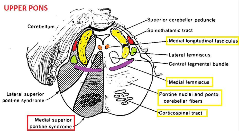 Postižení pontu Rostrální mediální pontinní syndrom ipsilaterálně: ataxie,ino, myoklonus patra kontralaterálně: