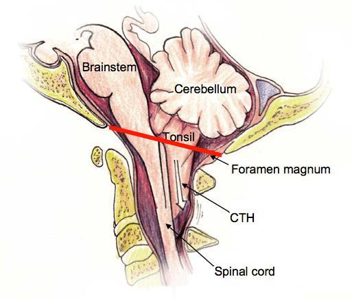 Další kmenové syndromy Syndrom foramen magnum centrální kvadruparéza porucha citlivosti na krku léze