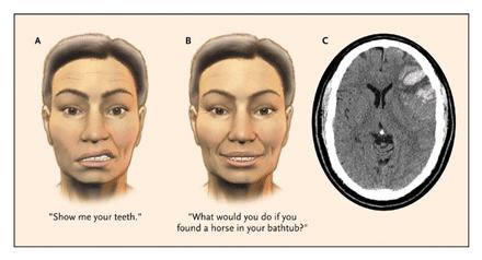 Při volním pohybu ( vyceňte prosím zuby ) je obrna n.facialis více vyjádřena než při emoční motorice ( co byste dělala, kdybyste našla ve vaně koně?