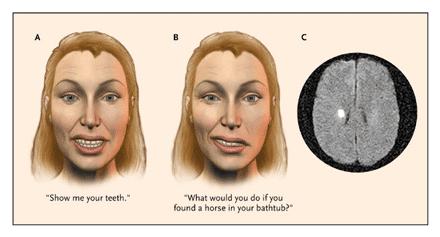 Obrna nervus facialis je více vyjádřena při emoční mimice než