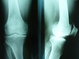 Obr. 1 Gonartróza (podle: http://www.ortopedie-traumatologie.