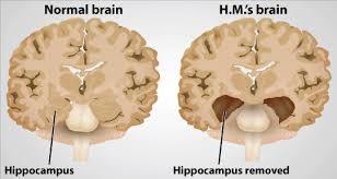 odstranění hipokampů Objevena
