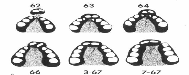deviovány na stranu zdravou. Septum na straně konvexity způsobuje různé stupně obstrukce. Převzato z McCatrhy, Plastic Surgery, Volume 4 Obr. č. 9.