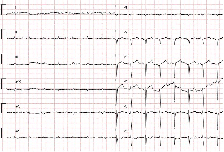 EKG