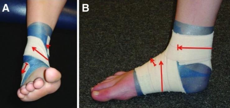 Obrázek 4 Reverse-6 taping (Cornwall et al., 2013, p. 383) Další možnost tapování ploché nohy může být i pomocí kinesiotapu.