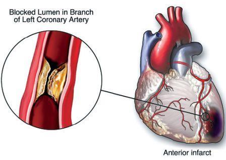 Akutní infarkt myokardu akutní koronární syndrom - akutní infarkt myokardu - nestabilní angina pectoris - náhlá srdeční smrt z koronární