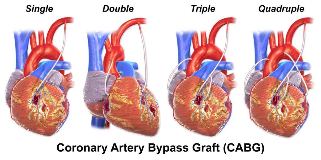 Definice AIM IM související s provedením aortokoronárního bypassu ( CABG) s elevaci ctn na desetinásobek + nové patologické kmity Q